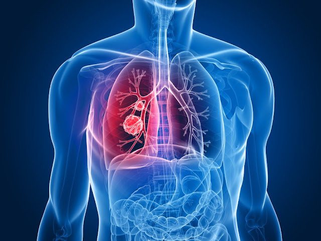 Malignant Mesothelioma, Asbestos, and Your Rights Malignant Mesothelioma, Asbestos, and Your Rights