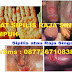 Harga Obat Sipilis