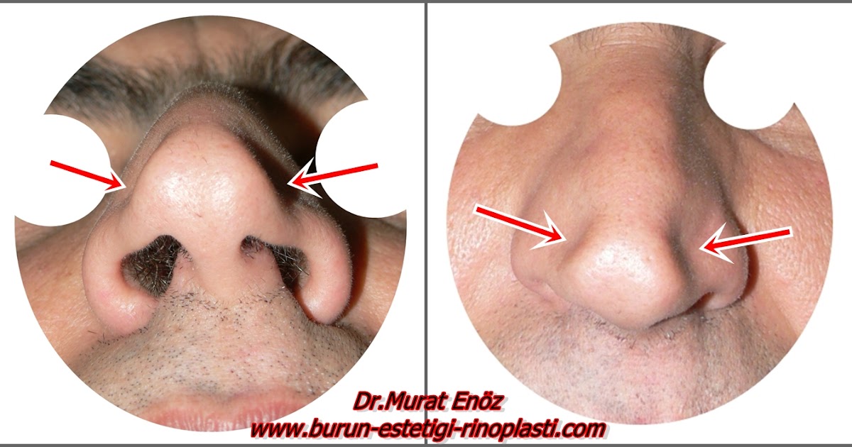 Alar Kollaps Tanımı, Belirtileri, Nedenleri ve Tedavisi Alar Kollaps Tanımı, Belirtileri, Nedenleri ve Tedavisi