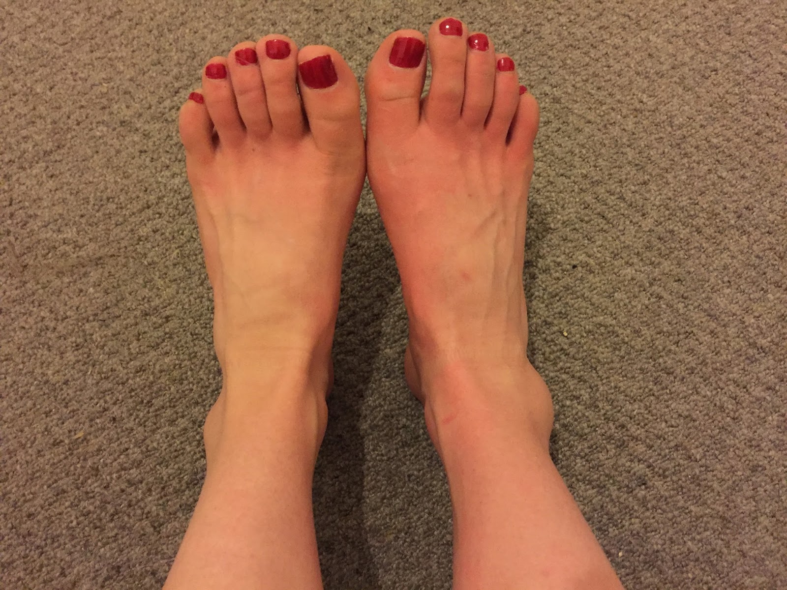 dealing-with-a-severe-ankle-sprain-performance-sports-therapy