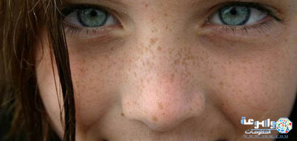 إزالة النمش في أسبوع