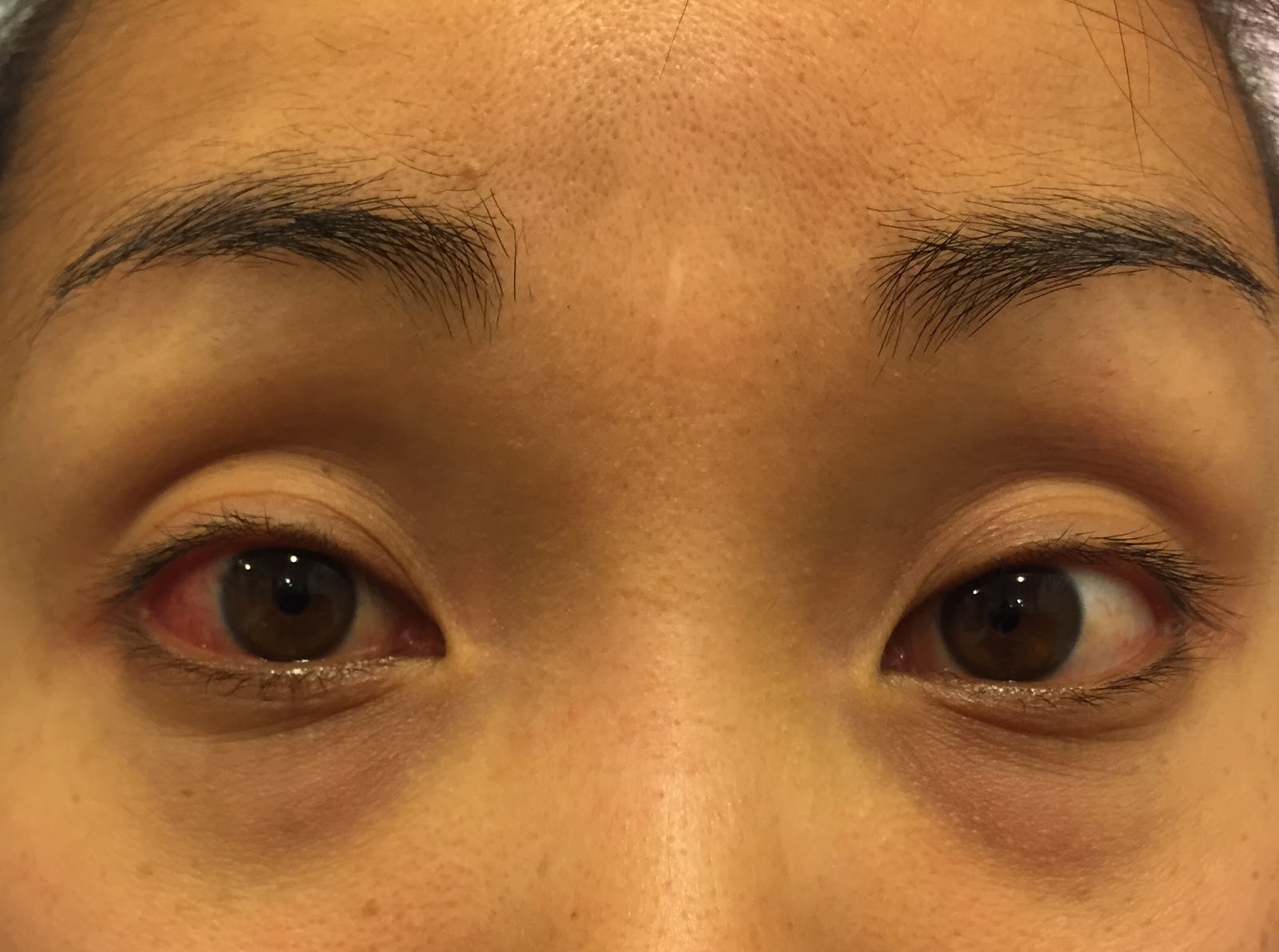 My eye Eyes before taking Doxycycline July 8, 2015
