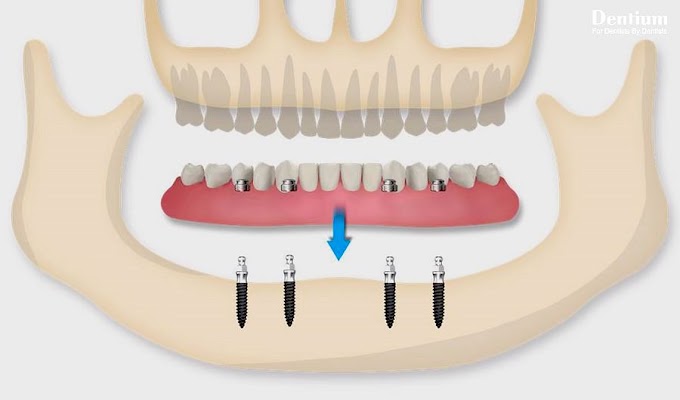 IMPLANTOLOGY: Implant supported mandibular overdenture - Dr Hyun Sik Park