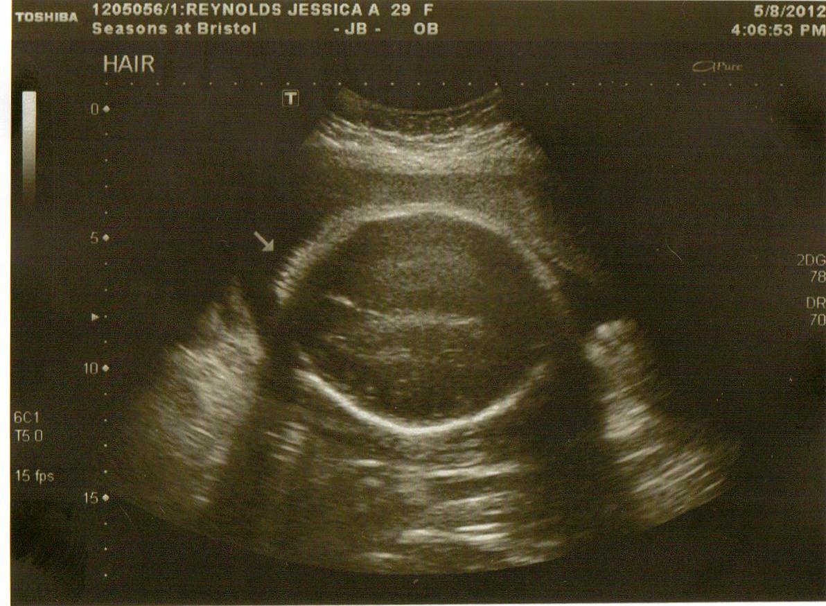 Baby At 33 Week Ultrasound