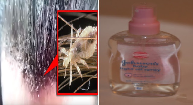 PERLU TAHU! Cukup Baby Oil Kutu Rambut Mati Sampai Telur