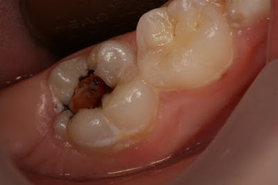 Răng bị sâu đến tủy có nguy hiểm không?