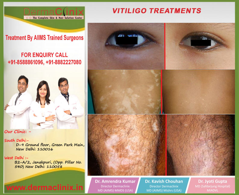 vitiligo treatment in delhi