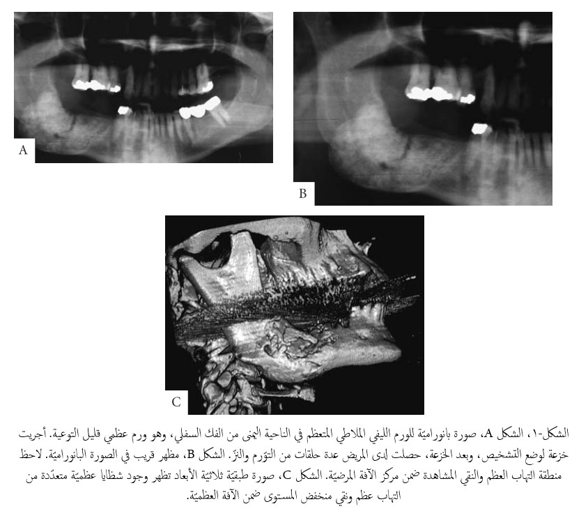 مترجمات فصل مترجم التهاب العظم والنقي وتمو ت العظم الشعاعي