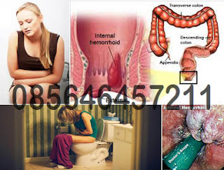 Obat Salep Benjolan Wasir Eksternal Meradang Obat Salep Benjolan Wasir Eksternal Meradang