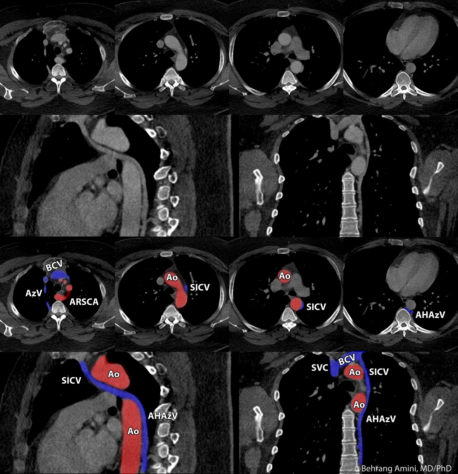 Roentgen Ray Reader Drainage of the Accessory Hemiazygos Vein into the