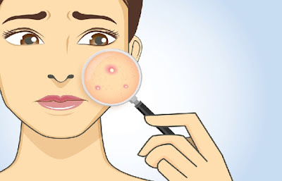 Acne Herbal Treatments Acne Herbal Treatments