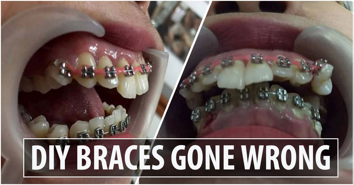 A Woman Whose DIY Dental Braces Terribly Gone Wrong NEWS INFO PHILIPPINES