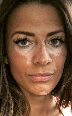 MODELO QUE ESCONDIO SU VITILIGO POR 10 AÑOS FINALMENTE REVELA SU PIEL. MODELO-CON-VITILIGO-BREANNE-RICE