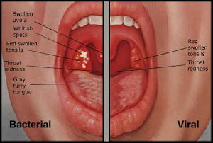 Strep Throat Rash Pictures | MedicalPictures.net