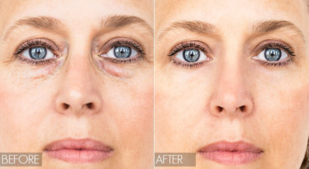How To Get Rid Of Bags Under The Eyes In A Few Days