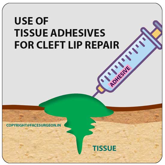 USE OF TISSUE ADHESIVES FOR CLEFT LIP REPAIR Richardson dental and