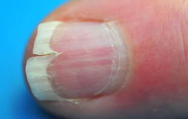 Cause of cracked nails - Awesome Nail