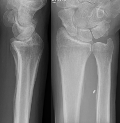 Secondary hypertrophic osteoarthropathy associated with squamous cell lung cancer