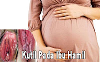 salep obat kutil kelamin yang aman untuk ibu hamil, Obat Kutil Kelamin Aman untuk Ibu Hamil dari Ramuan Tradisional