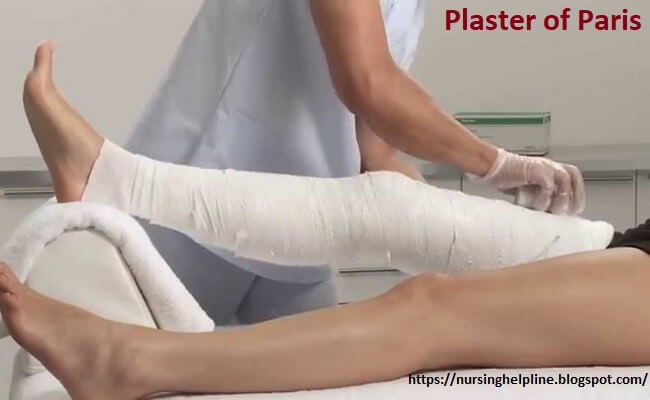 Plaster of Paris splint in orthopedics