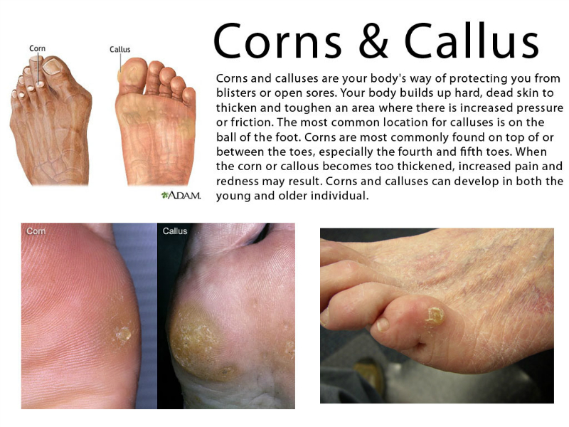 Weirdlavender .blogspot Life Style Rawat Bunion sebelum parah.