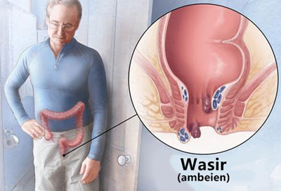 Penyakit Wasir