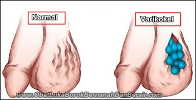Cara Mengobati Varikokel Tanpa Harus Operasi Sampai Sembuh Total Cara Mengobati Varikokel Tanpa Harus Operasi Sampai Sembuh Total