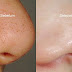9 Tips Berkesan Hilangkan Blackhead Pada Wajah