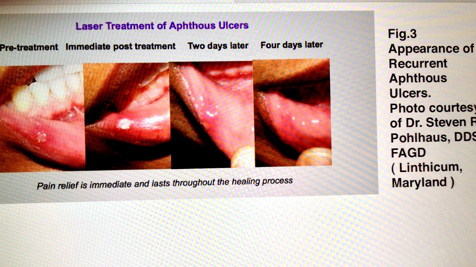 How To Treat Mouth Ulcers Ulcer Choices
