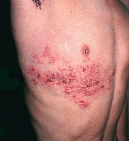 nama obat herpes dan simplek di apotik nama obat herpes dan simplek di apotik
