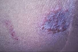 Obat Tradisional untuk Menyembuhkan Borok di Selangkangan