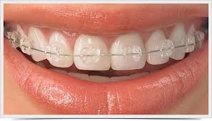 ortodoncia estética