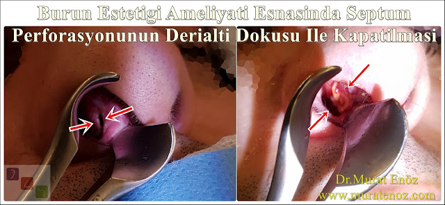 Deri altı dokusu ile septum perforasyonu tamiri - Deri altı dokusu ile septum perforasyonu ameliyatı - Septum perforasyonu tedavisi - Nazal septum perforasyonu operasyonu - Açık teknik septum perforasyonu ameliyatı - Açık teknik septum perforasyonu onarımı - Burun estetiği ile birlikte septum perforasyonu kapatılması - Burun septumunda delik kapatılması - Burun septum perforasyonu ameliyatı - Septum perforation closure in Istanbul - Septum perforation closure with under skin tissue - Closure of nasal septal perforations using under skin tissue - Combining rhinoplasty with septal perforation repair Deri altı dokusu ile septum perforasyonu tamiri - Deri altı dokusu ile septum perforasyonu ameliyatı - Septum perforasyonu tedavisi - Nazal septum perforasyonu operasyonu - Açık teknik septum perforasyonu ameliyatı - Açık teknik septum perforasyonu onarımı - Burun estetiği ile birlikte septum perforasyonu kapatılması - Burun septumunda delik kapatılması - Burun septum perforasyonu ameliyatı - Septum perforation closure in Istanbul - Septum perforation closure with under skin tissue - Closure of nasal septal perforations using under skin tissue - Combining rhinoplasty with septal perforation repair