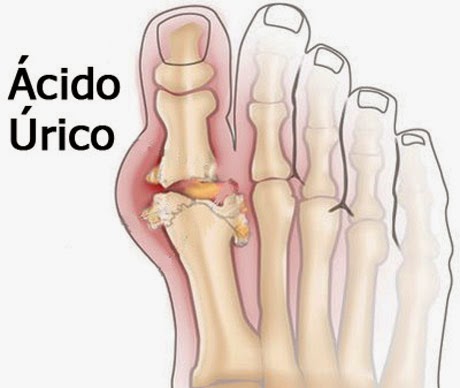 Como bajar los niveles de acido urico de forma natural Como bajar los niveles de acido urico de forma natural