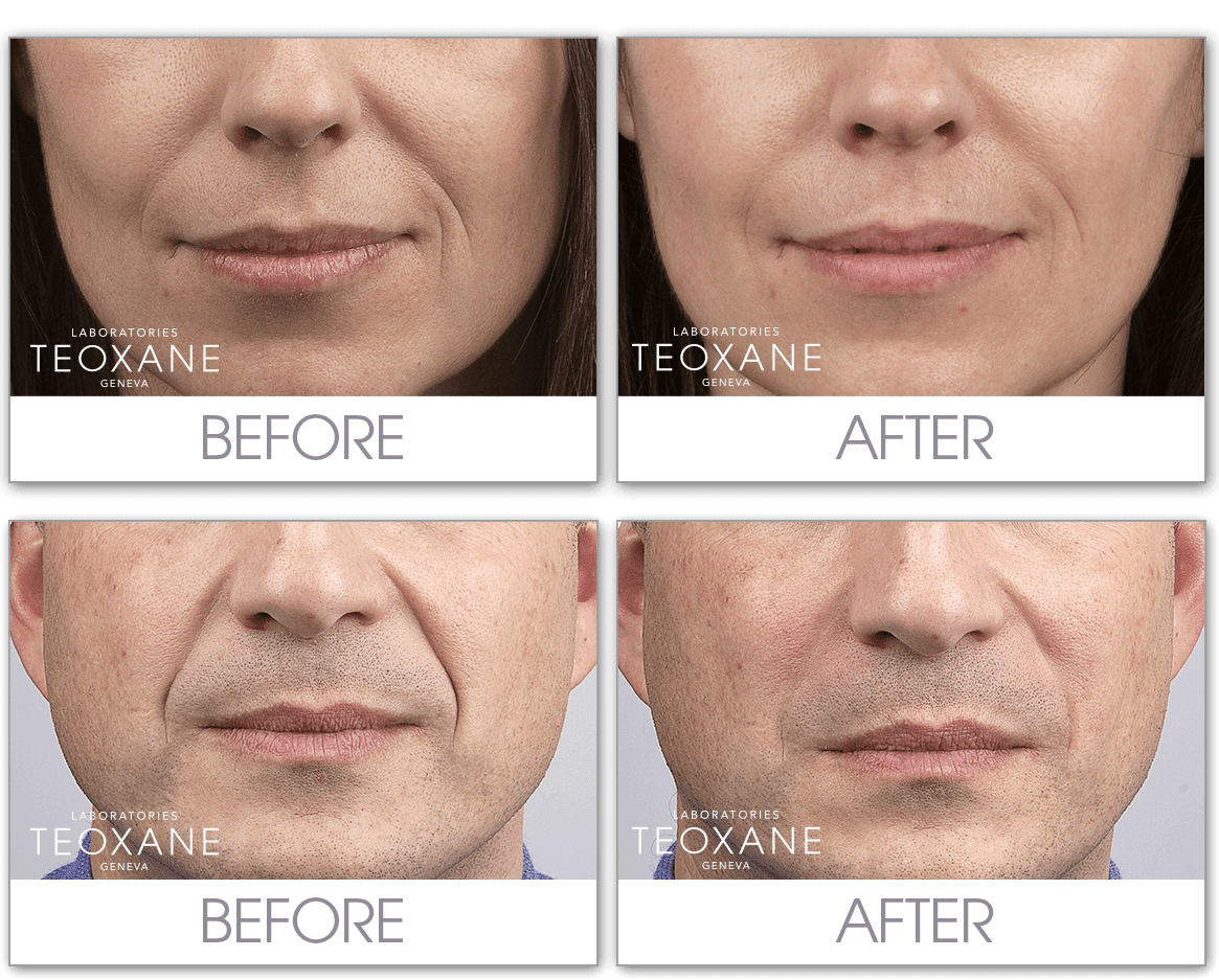 Freshen up your face with Teosyal Dermal Filler! Beauty Crazed in Canada
