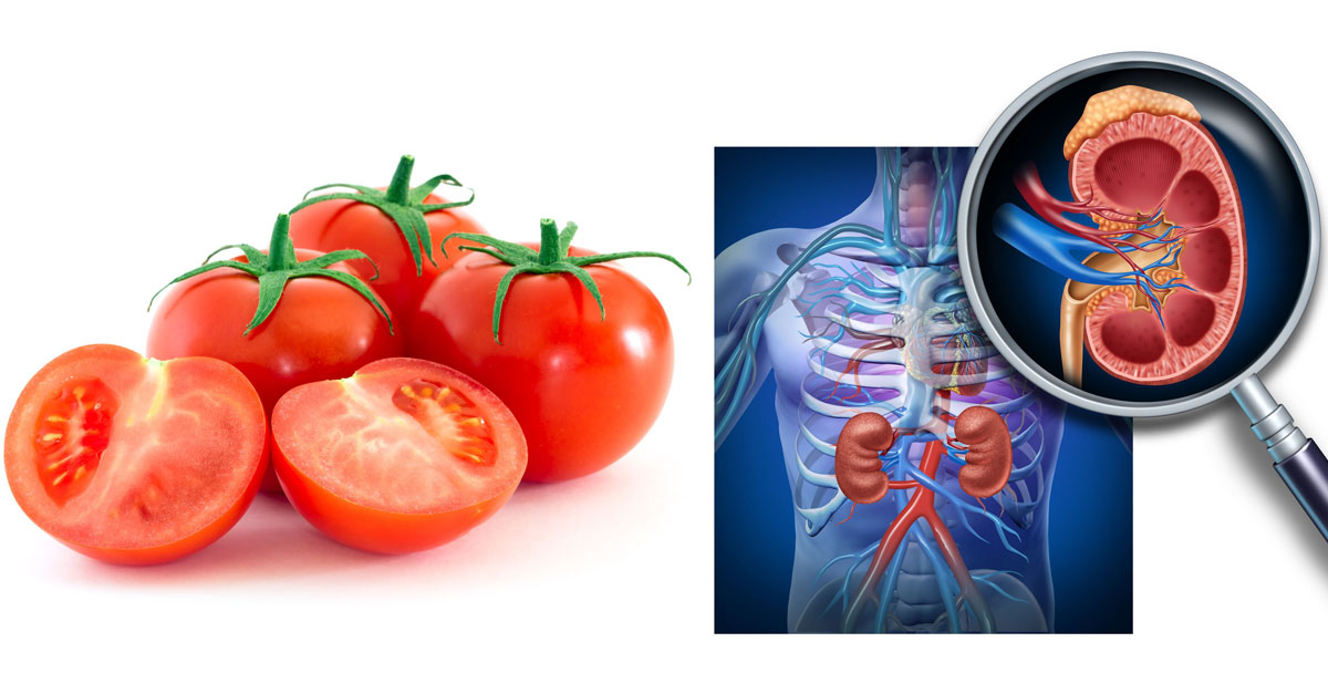 Health & Fitness Do you think the tomato causes the kidney stone