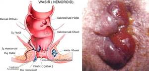 Obat Wasir Apotik