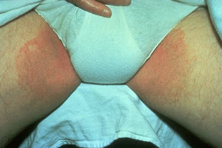 penyakit gatal jamur kulit disekitar selangkangan dan kemaluan wanita apa obatnya