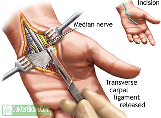 CTS Carpal Tunnel Syndrome - Penyebab Gejala Dan Cara Mengobatinya Secara Alami Tradisional Ampuh CTS Carpal Tunnel Syndrome - Penyebab Gejala Dan Cara Mengobatinya Secara Alami Tradisional Ampuh