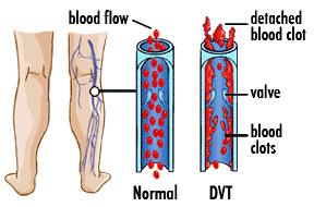 Deep Vein Thrombosis, DVT