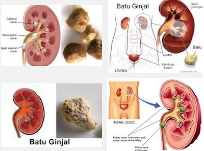 Obat Penghancur Batu Ginjal Yang Paling Manjur di Apotik 100% Aman Utk Semua Usia Obat Penghancur Batu Ginjal Yang Paling Manjur di Apotik 100% Aman Utk Semua Usia