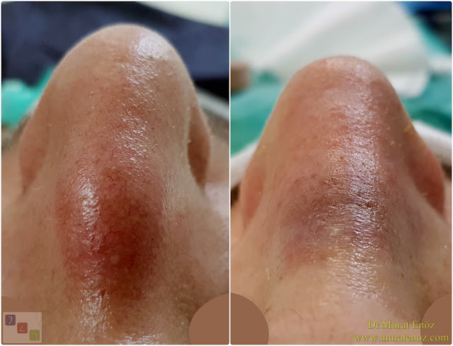 Erkek burun estetiği modelleri - Erkek burun estetiği öncesi ve sonrası - Erkek burun estetiği görüntüleri - Erkek burun estetiği fotoğrafları - Erkek burun estetiği fiyatları - Erkek burun estetiği nasıl olmalı? - Erkeklerde burun estetiği - Erkeklerde rinoplasti operasyonu - Rhinoplasty in men Istanbul - Rhinoplasty for men in Turkey - Male rhinoplasty Istanbul - Nose job in men Istanbul Erkek burun estetiği modelleri - Erkek burun estetiği öncesi ve sonrası - Erkek burun estetiği görüntüleri - Erkek burun estetiği fotoğrafları - Erkek burun estetiği fiyatları - Erkek burun estetiği nasıl olmalı? - Erkeklerde burun estetiği - Erkeklerde rinoplasti operasyonu - Rhinoplasty in men Istanbul - Rhinoplasty for men in Turkey - Male rhinoplasty Istanbul - Nose job in men Istanbul