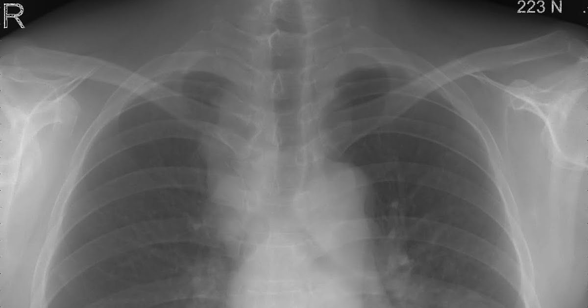 VIETNAMESE MEDIC ULTRASOUND CASE 546 LUNG CANCER, Dr PHAN THANH HAI