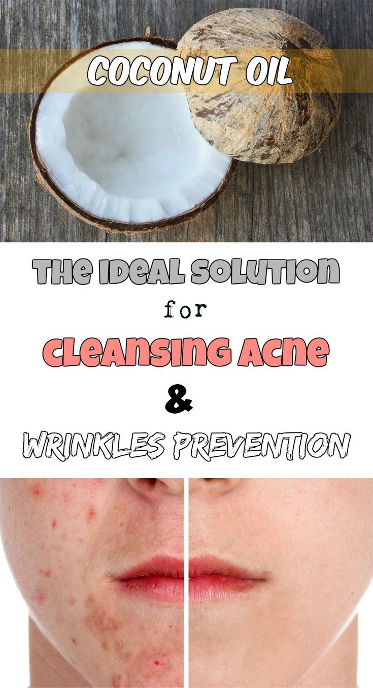 Coconut Oil For Acne