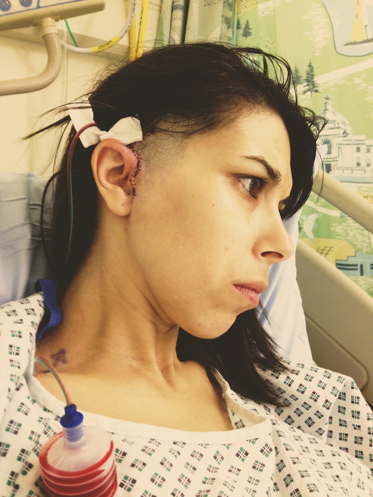 TMJ diaries: The surgery