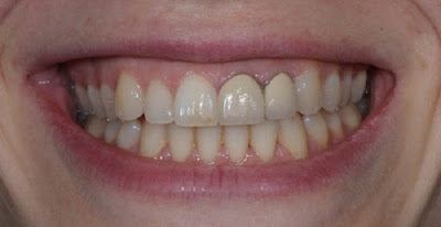  Cạo vôi răng có làm trắng răng không? 