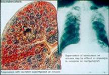 โรคปอดฝุ่นทรายหรือซิลิโคสิส silicosis