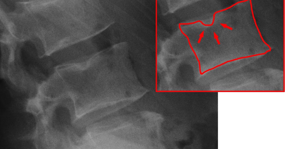 субхондральный синдром замыкательных пластинок тел позвонков. субхондральный остеосклероз замыкательных пластинок.