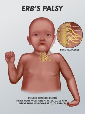 physio for life erb s palsy erb palsy