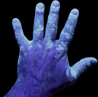 Fotografía bajo luz UV de una mano con vitíligo.